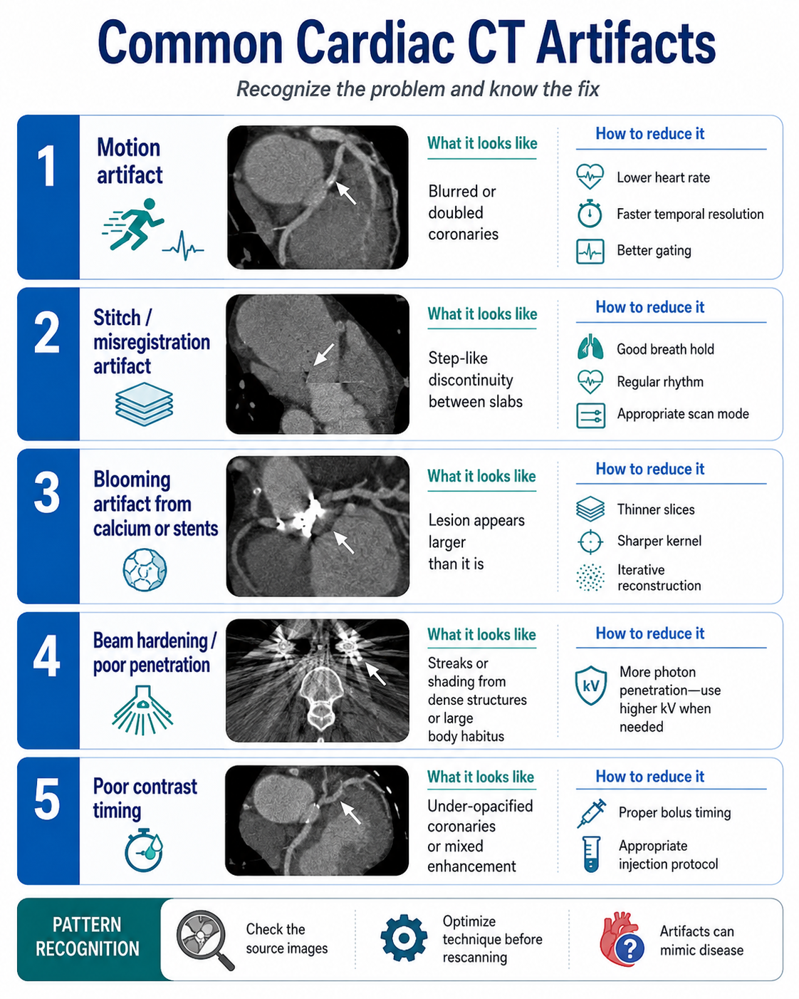 Common cardiac CT artifacts — motion, stitch/misregistration, blooming, beam hardening, and poor contrast timing, with how to recognize and reduce each