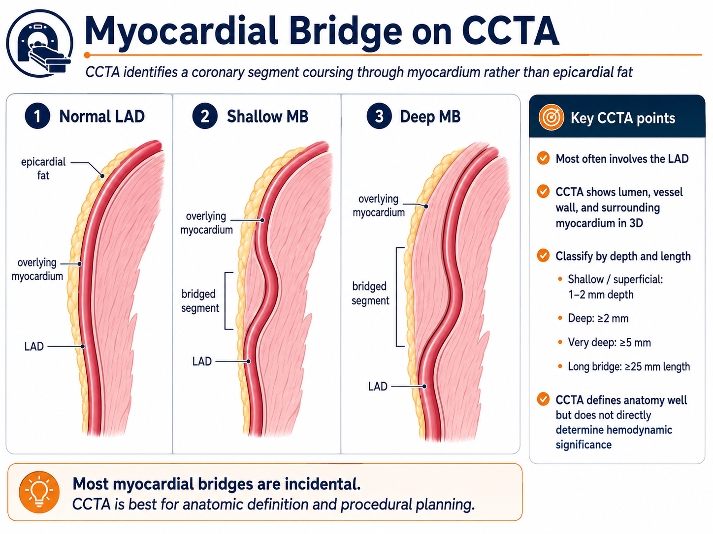 Myocardial bridge on CCTA — normal LAD in epicardial fat vs shallow bridge (1–2 mm depth) vs deep bridge (≥2 mm), with key CCTA classification points