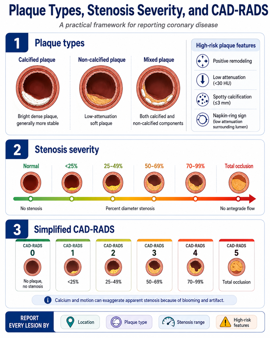 Plaque types, stenosis severity, and CAD-RADS