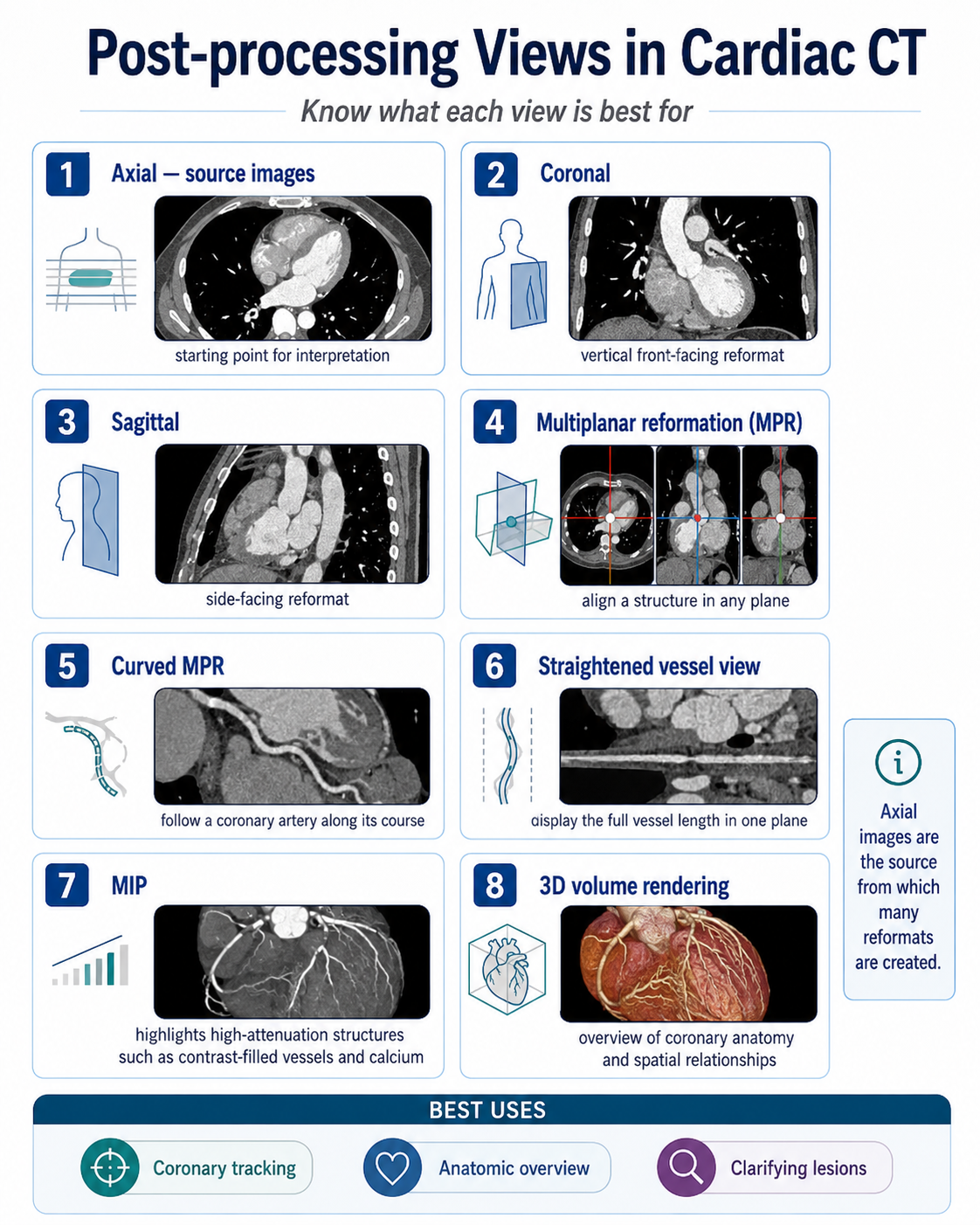 Post-processing views in cardiac CT — axial, coronal, sagittal, MPR, curved MPR, straightened vessel, MIP, and 3D volume rendering